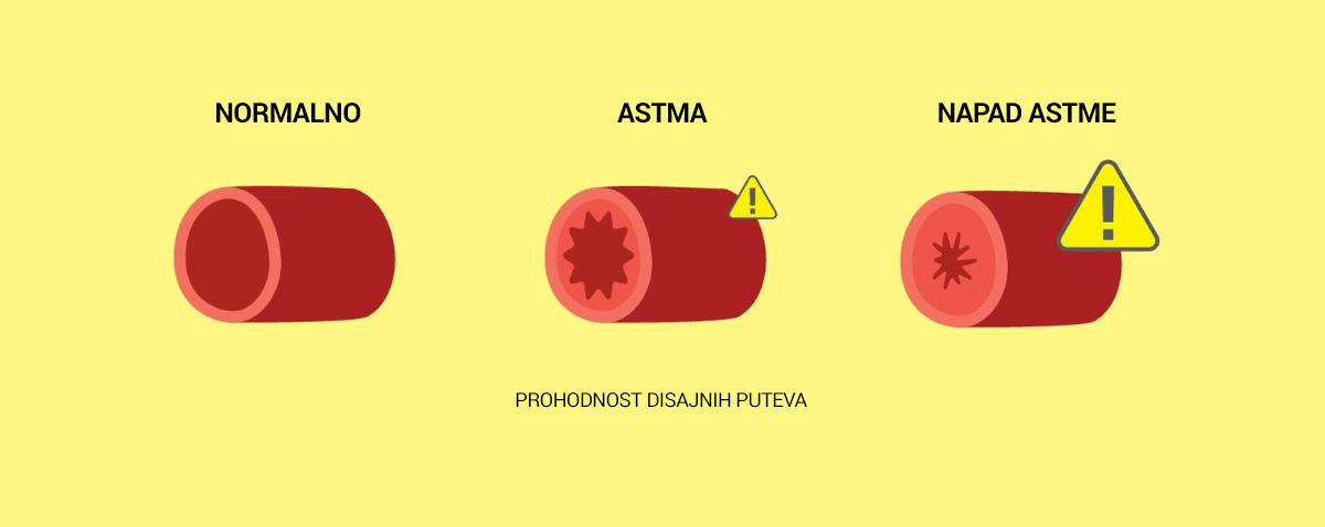 astma